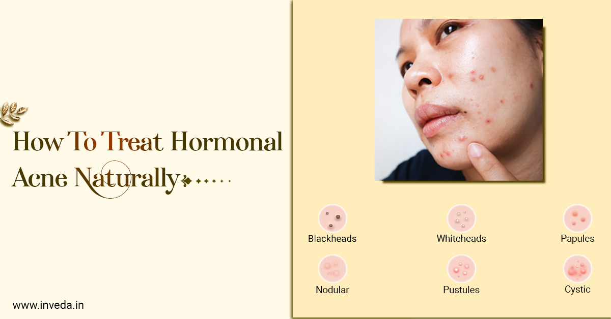 Hormonal acne on sale natural treatment